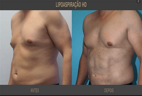 Lipo LAD como funciona Efeitos indicações e mais