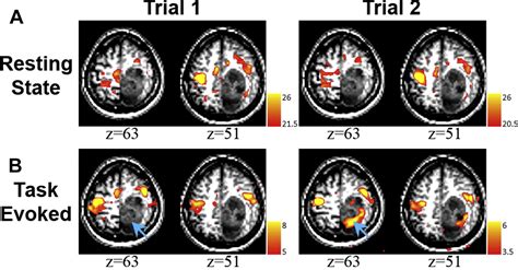 Resting State Blood Oxygen Leveldependent Functional Magnetic