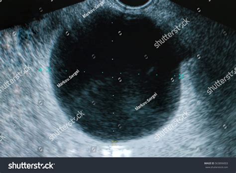 Ovarian Cyst Medical Ultrasound Diagnostics Stock Photo 563896003 ...