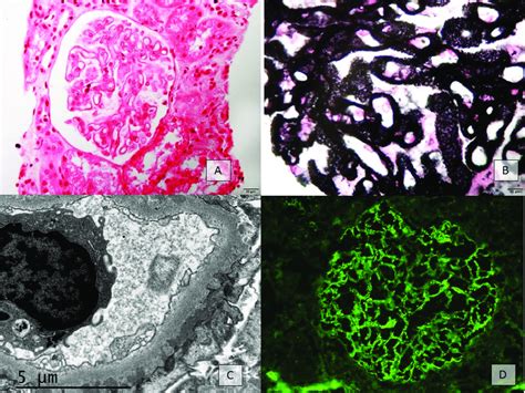 Membranous Nephropathy Histology