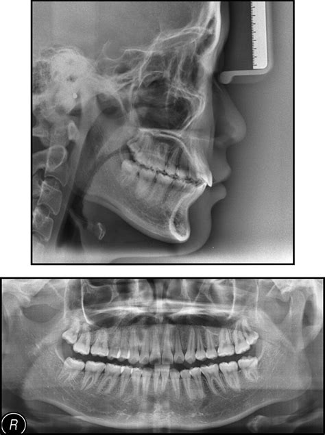 Use Of Forsus Fatigue Resistant Device In A Patient With Class I