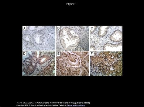 Nuclear Kaiso Indicates Aggressive Prostate Cancers And Promotes