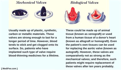 Surgery For Replacement Of Aortic Valve Risks And Faqs