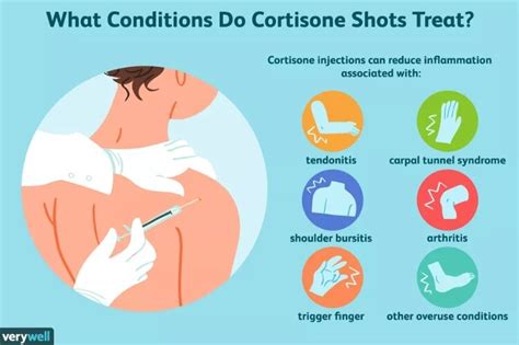 Cortisone Injections Vs Posture Therapy — Posture First Exercise Therapy