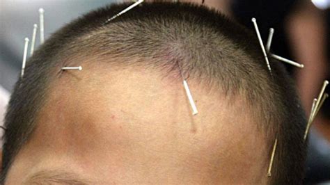 Scalp Acupuncture – Kathleen Leavy, R.N., A.P.