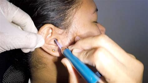 Woman S Dry Earwax Removal Using Lighted Ear Curette YouTube