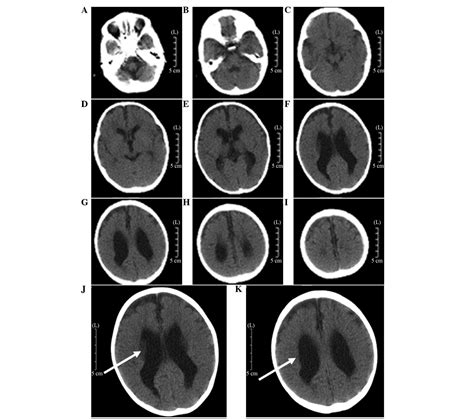 Periventricular Leukomalacia