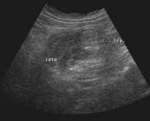 Colocolic Intussusception With Lipoma As The Leading Point Applied