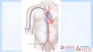 Heart Stent Procedure Demystify - By Dr Tan Chong Hiok | PPT