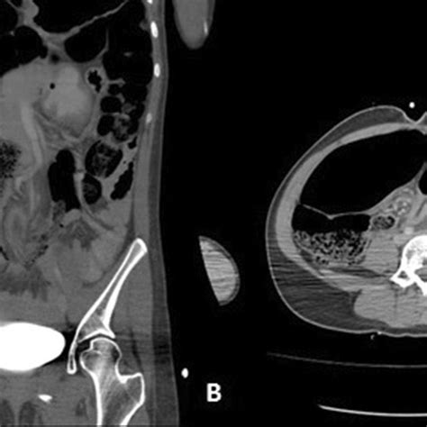 A. Sigmoid Volvulus Observed on Axial Cross-Section with CT B. Sigmoid ...