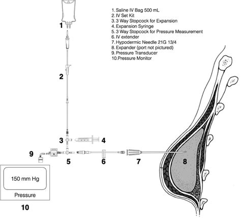 Schematic Of The Tissue Expander Fill System Used To Measure Tissue Download Scientific Diagram