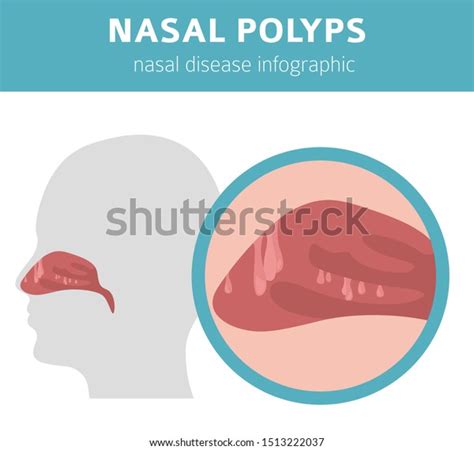 Nasal Polyps Asthma: Over 8 Royalty-Free Licensable Stock Vectors & Vector Art | Shutterstock