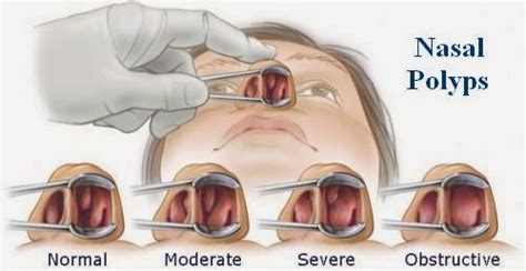 Nasal Polyps