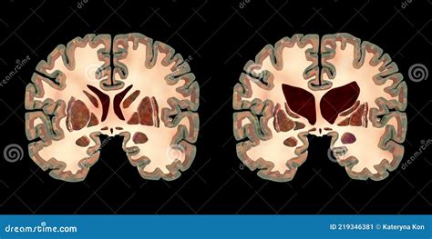 Brain Atrophy In Huntingtons Disease Cartoon Vector | CartoonDealer.com ...