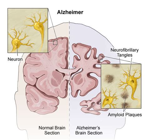 Alzheimer Disease Health Encyclopedia University Of Rochester Medical Center