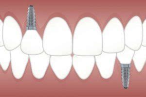 My Dental Implant Fell Off Now What Dental Town Dc Blog