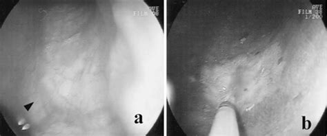 Figure From Treatment Of Superficial Esophageal Cancer By Argon