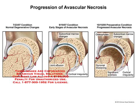 ORTHOPAEDICS: Avascular Necrosis of Bone