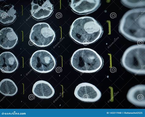 Exploración Del CT Y MRI Del Cerebro Infarto Cerebral De La