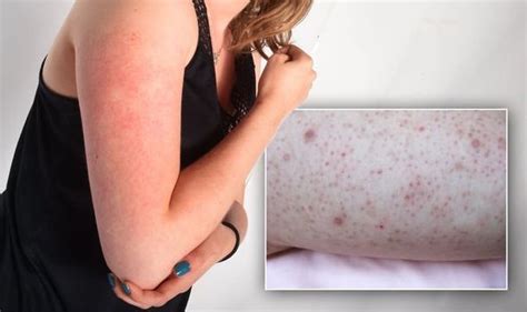 How To Get Rid Of Small Red Bumps At The Top Of Your Arms What Is The Condition Uk