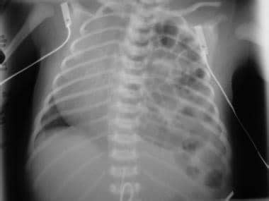 Congenital Diaphragmatic Hernia CDH Imaging Practice Essentials