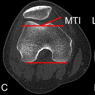 Schema of measured trochlea morphology and patellofemoral joint ...