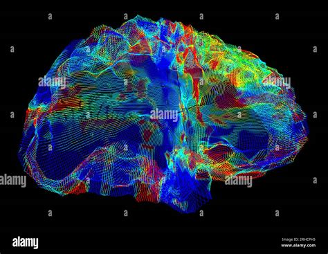 Brain in Alzheimer's disease, DTI MRI scan Stock Photo - Alamy