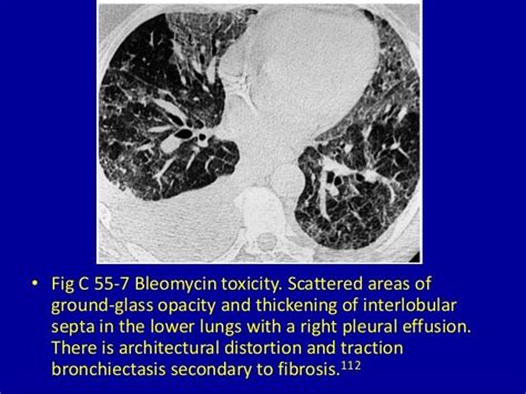 55 basilar predominant disease