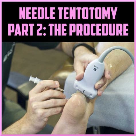 Percutaneous Ultrasound Guided Needle Tenotomy Part 2 The Procedure