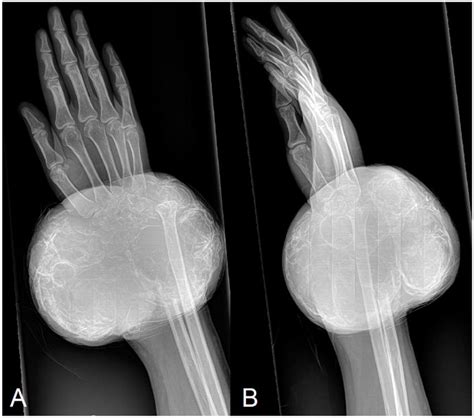 A B Initial Anteroposterior A And Lateral B Radiographs