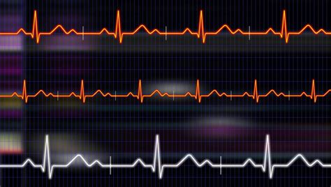 Fibrillazione Atriale Cos E Perch Importante Lo Screening Per