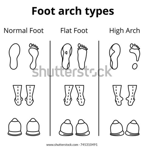 Foot Arch Types Vector Infographics Set Stock Vector (Royalty Free) 745310491