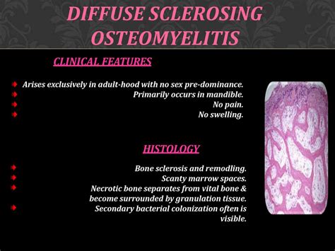 Diffuse Sclerosing Osteomyelitis