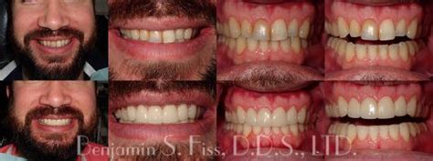 Porcelain Veneers In Chicago Il Chicago Benjamin S Fiss D D S