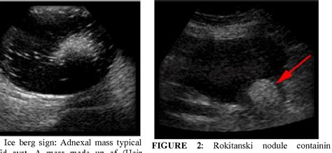 Figure 3 From Diagnostic Value Of Sonography In Ovarian Dermoid Cysts