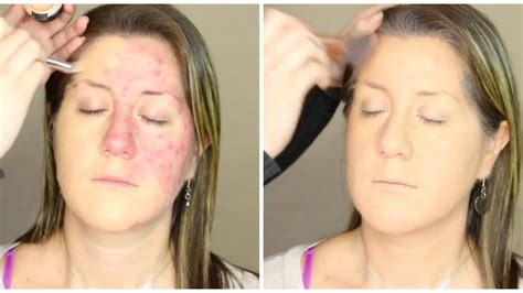 This Acne Makeup Makeover Post Has Gone Viral — And It's Causing a Lot ...