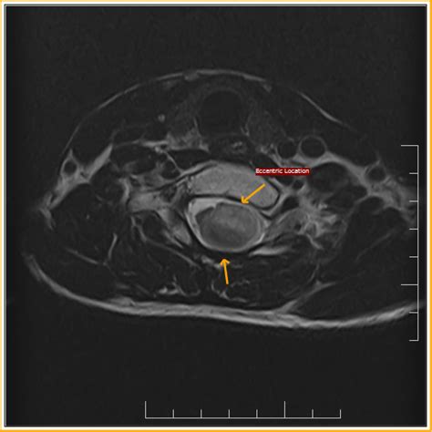 Spinal Ganglioglioma-MRI - Sumer's Radiology Blog