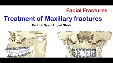 Treatment Of Maxillary Fractures Oral Maxillofacial Surgery Syed