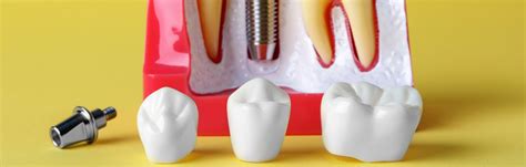 In Depth Guide To Types Of Dental Crowns