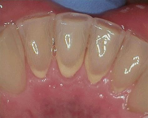 Dental Calculus Tartar