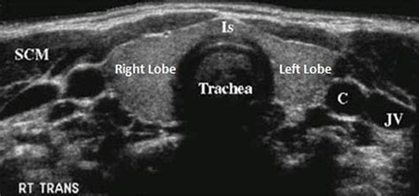 Thyroid Anatomy Ultrasound