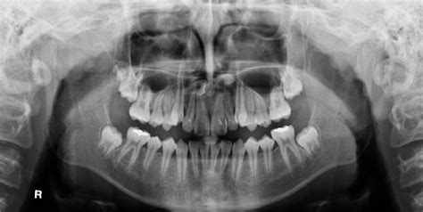 Two Supernumerary Teeth Is Seen On Anterior Maxilla Area Download Scientific Diagram