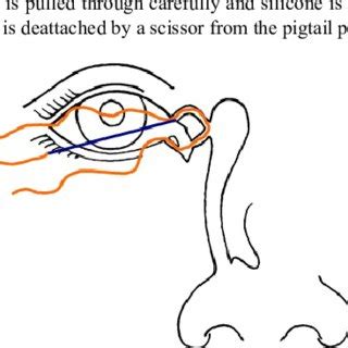 If Bicanalicular Intubation Is Wanted Third Stage Is Performed In