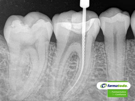 Qu Se Debe Hacer Antes De Una Endodoncia Antes De Realizar Una