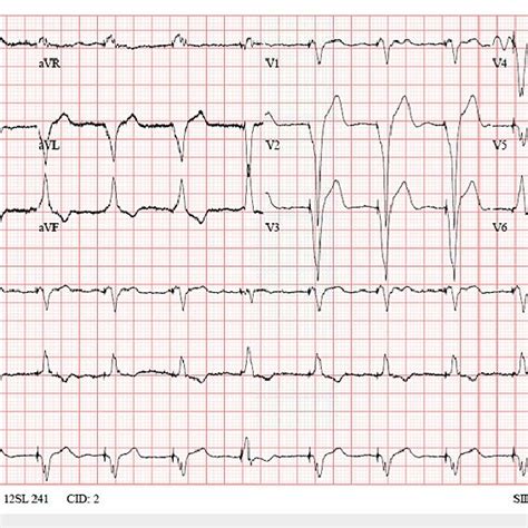 Electrocardiography Ecg Days Post Hospital Admission Showed