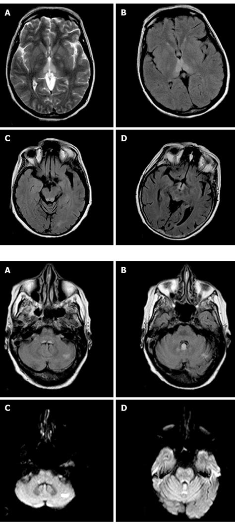 Magnetic Resonance Images In A Patient With Nonalcoholic Wernicke S