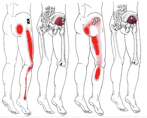 Trigger Points In Gluteus Maximus Find Them And Treat