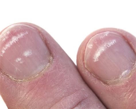 What Causes White Spots On Nails Leukonychia