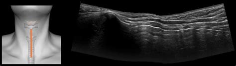 Airway Ultrasound Longitudinal Views LITFL Ultrasound Library