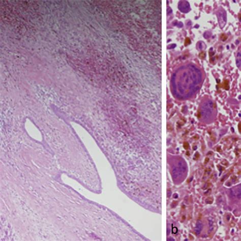 Temporal artery biopsy from a patient with giant-cell arteritis taken ...